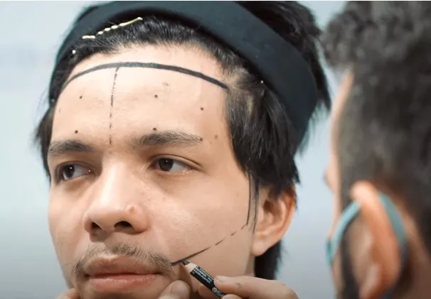 Atta Halilintar Ikut Transplantasi Rambut, Ingin Perbaiki Jidat yang Lebar 2