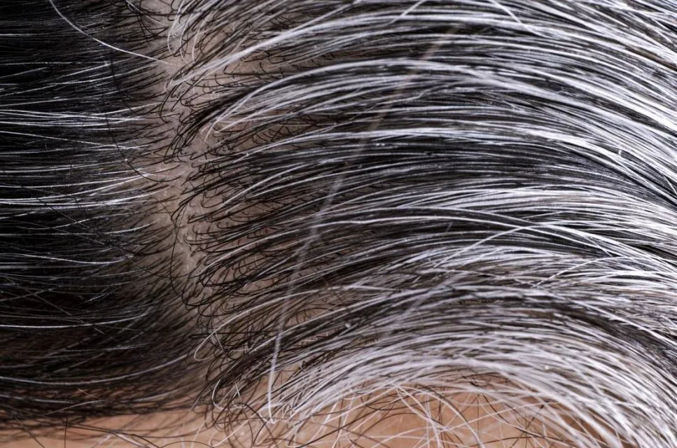 Rambut Bermasalah Bisa Jadi Tanda Tubuh Alami 6 Hal ini 7 Kondisi rambut bisa tunjukan kondisi tubuh