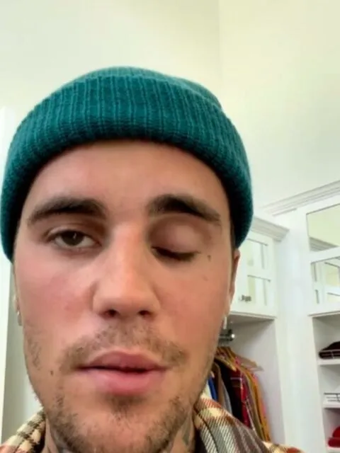 Bikin Fans Khawatir, Mata Kanan Katy Perry Menutup Sendiri dan Sulit Dibuka Saat Konser 2 Justin Bieber idap Ramsay Hunt Syndrome