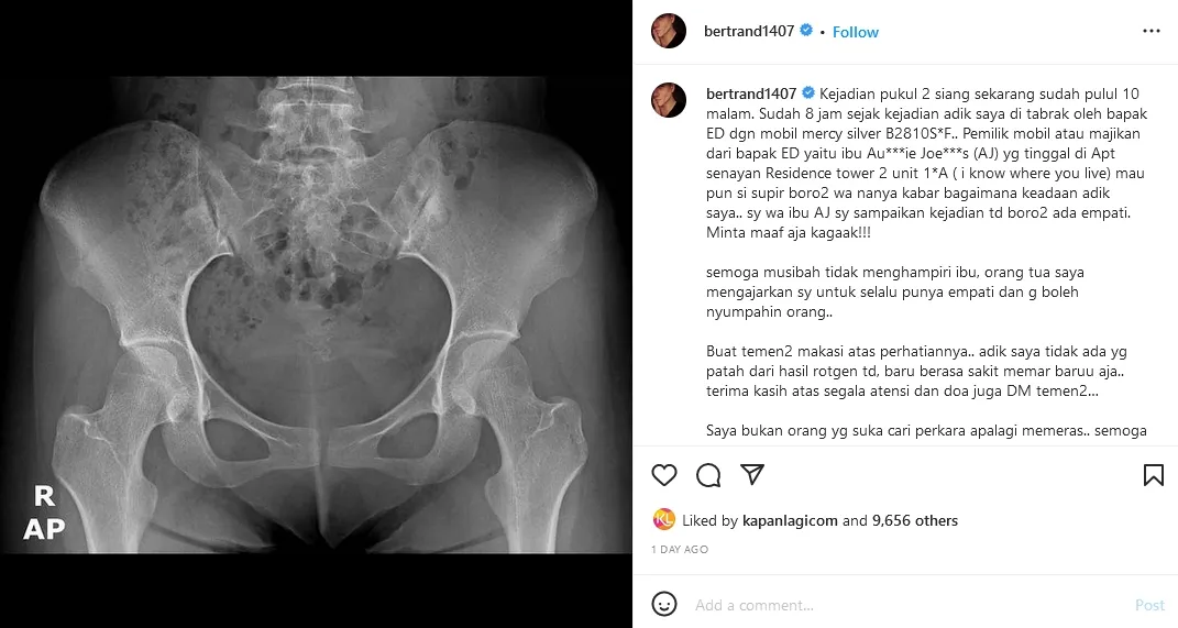 Adiknya Ditabrak Mobil, Bertrand Antolin Geram Pelaku Tawari Uang Damai 4 Kondisi terkini adik Bertrand