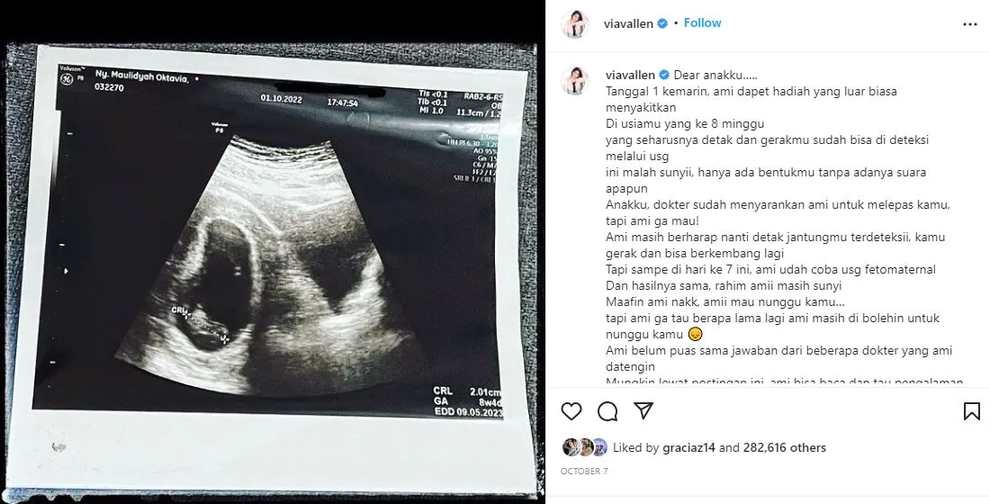 Sempat Berusaha Pertahankan Kandungan, Via Vallen Tulis Pesan Pilu Usai Relakan Janinnya Gugur 2 Via Vallen keguguran