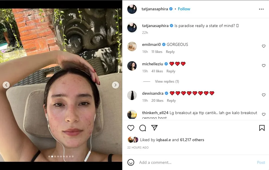 Tatjana Saphira Ekspos Kulit Wajah Berjerawat, Ingatkan Warganet untuk Lebih Berempati 5 Tatjana pamer potret wajah tanpa riasan