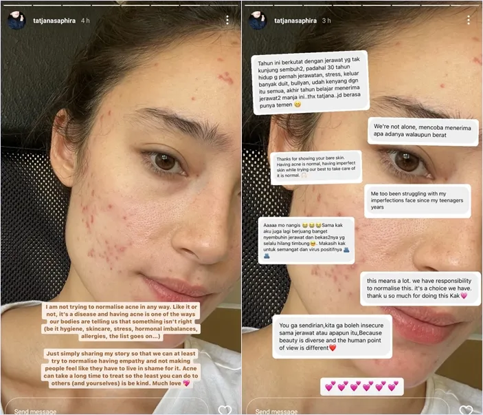 Tatjana Saphira Ekspos Kulit Wajah Berjerawat, Ingatkan Warganet untuk Lebih Berempati 8 Pesan Tatjana untuk yang suka membully orang jerawatan