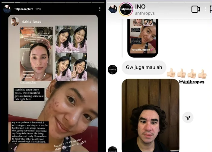 Tatjana Saphira Ekspos Kulit Wajah Berjerawat, Ingatkan Warganet untuk Lebih Berempati 7 Menginspirasi warganet