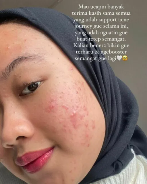 Jadi Pejuang Jerawat, Ratu Ghania Curhat Dapat Banyak Hate Comments. Kini Banjir Dukungan! 2 Ratu Ghania