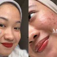 Jadi Pejuang Jerawat, Ratu Ghania Curhat Dapat Banyak Hate Comments. Kini Banjir Dukungan!