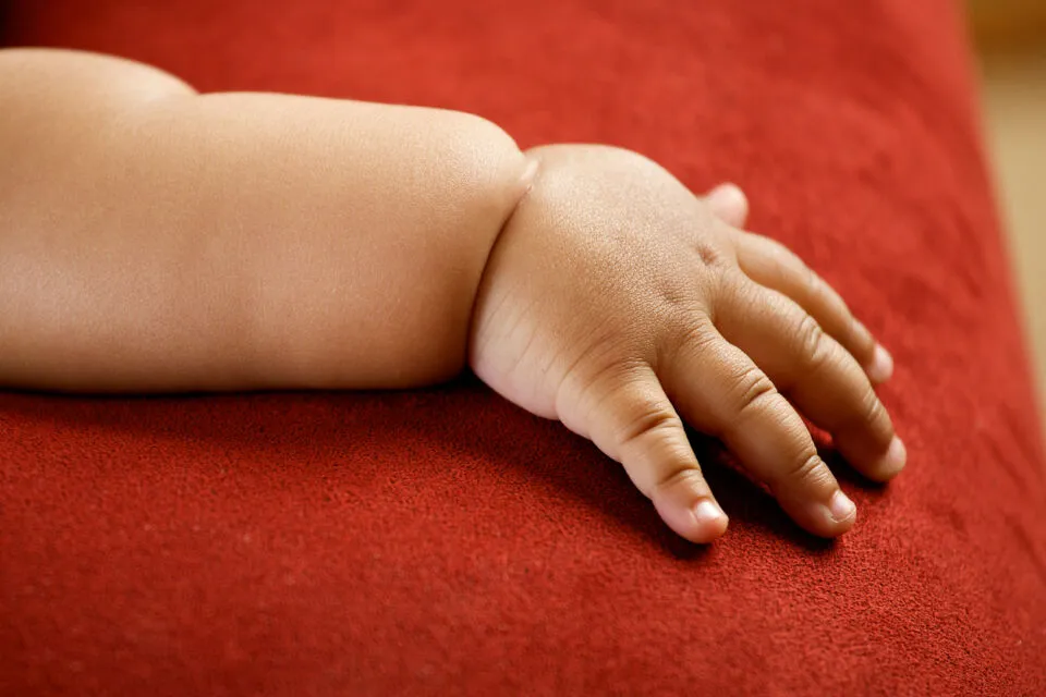 Sempat Viral, Begini Kondisi Bayi Obesitas yang Baru 16 Bulan Beratnya Badan 27 Kg 2 bayi obesitas