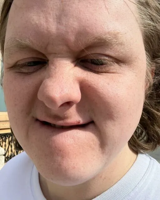7 Artis yang Mengidap Sindrom Tourette, Mulai dari David Beckham Hingga Terbaru Lewis Capaldi 14 Lewis Capaldi