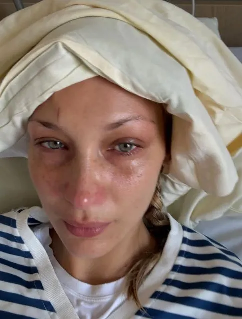 5 Fakta Mengejutkan Seputar Lyme Disease Bella Hadid yang Wajib Diketahui Sebagai Bentuk Awareness 13 lyme disease- penyakit kronis