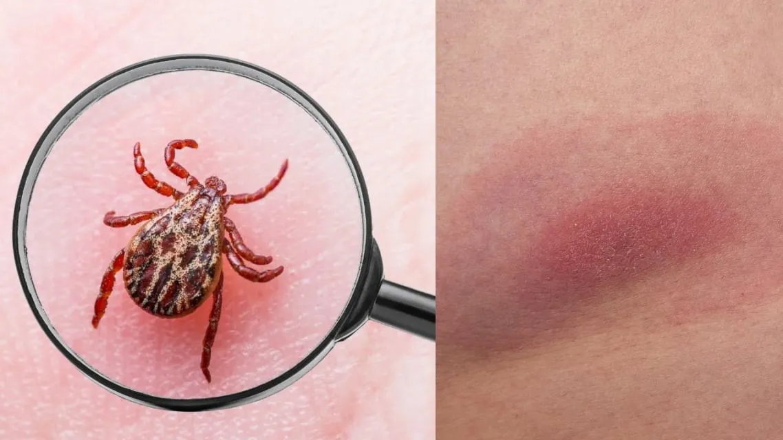 5 Fakta Mengejutkan Seputar Lyme Disease Bella Hadid yang Wajib Diketahui Sebagai Bentuk Awareness 11 lyme disease-penyebab