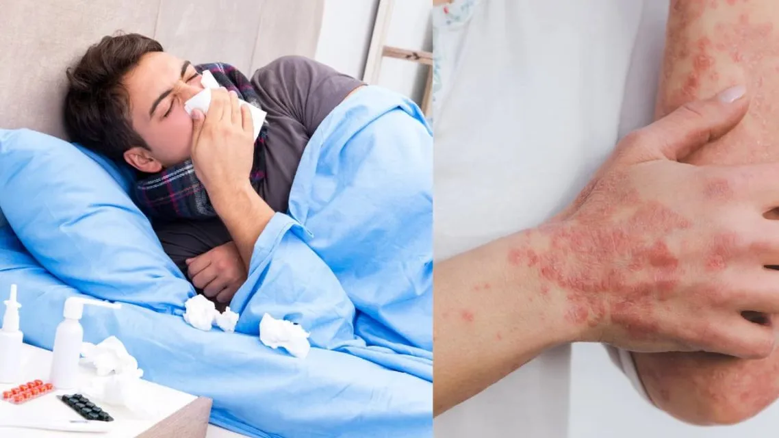 5 Fakta Mengejutkan Seputar Lyme Disease Bella Hadid yang Wajib Diketahui Sebagai Bentuk Awareness 12 Lyme Disease-gejala awal spt flu
