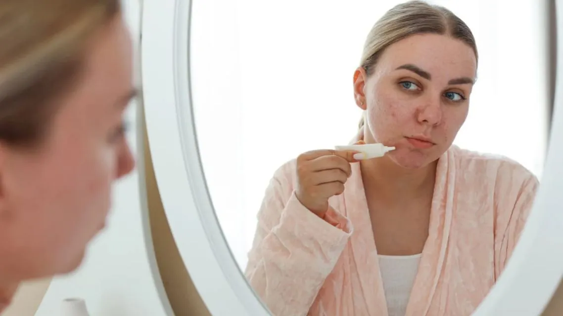 Skincare Routine di Musim Hujan: 10 Tips & Hacks biar Kulit Tetap Glowing 19 spot tratment di area yang memerlukan